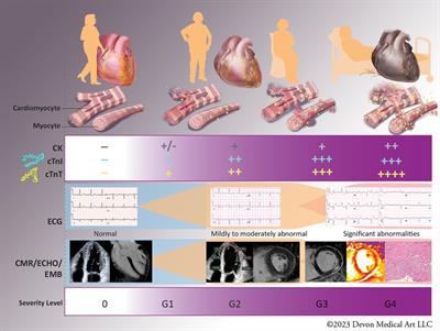 Circulating biomarkers in the diagnosis and prognosis of immune checkpoint inhibitor-related myocarditis: time for a risk-based approach